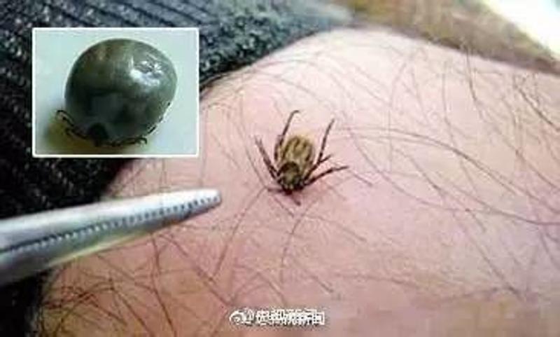 小伙感染鬼脸虫引发腹泻，警惕寄生虫病的威胁