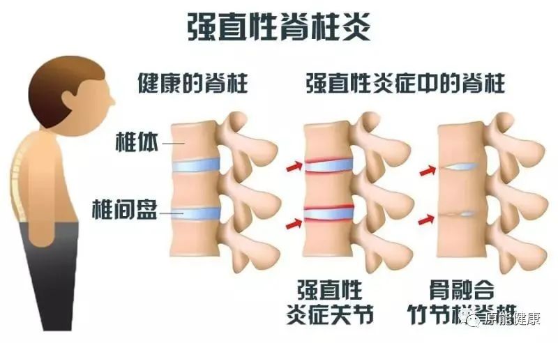 公务员隐瞒强直性脊柱炎