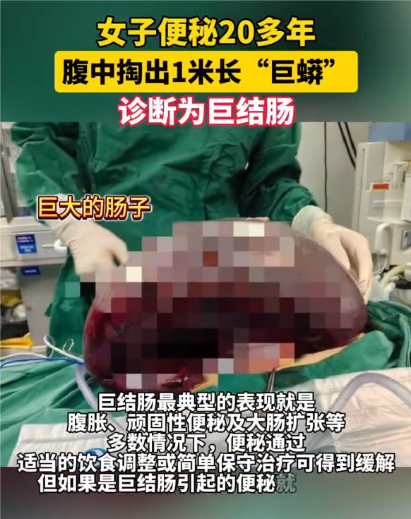 女子结肠巨蟒般盘踞腹中，长年便秘困扰生活