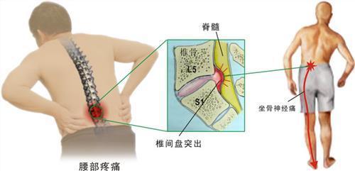 九岁小胖墩遭遇腰椎间盘脱出，健康警钟敲响之际